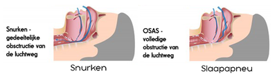 Slaapapneu, wat is dat? 